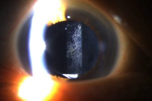 Posterior-Capsule-Opacity-PCO-Cataract-Asia-Pacific-Eye-Centre-APEC-2-ohd6agv5no0ljas0rev8meoxazmfe6tyonb77boxb4