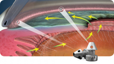 Glaucoma-iStent-Inject-Process-Animation-1024x580