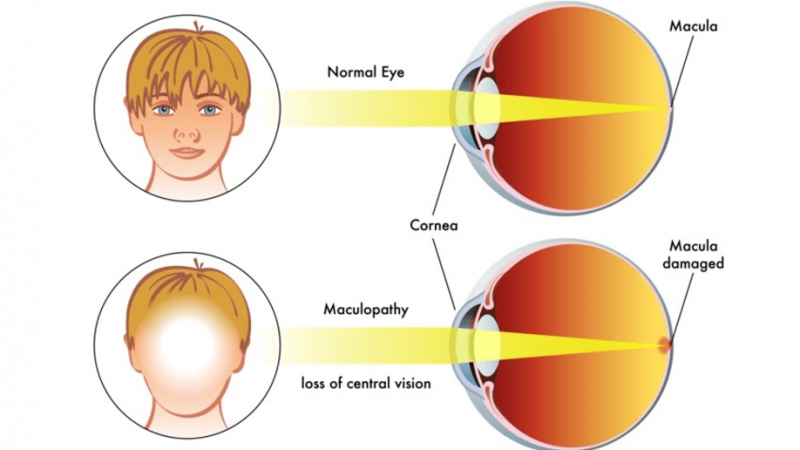 Recognizing the Early Signs Macular Degeneration Symptoms You Shouldn’t Ignore