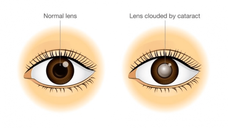 What to Expect Before, During, and After Cataract Surgery